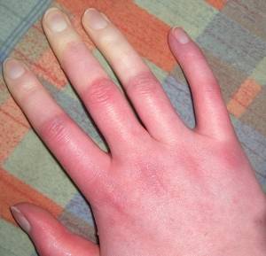 raynaud szindróma